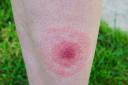 What is Lyme disease and what symptoms should you look out for?